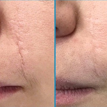 Шлифовка шрама Тимченко.jpg