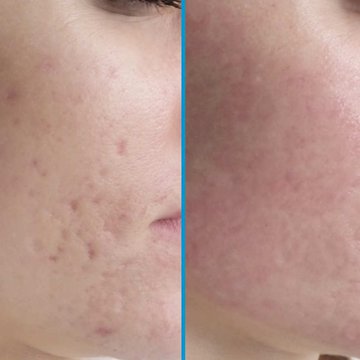 шлифовка рубцов фото до и после Тимченко.jpg