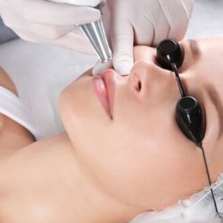 Удаление татуажа лазером